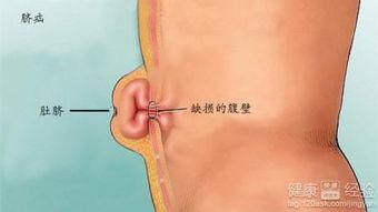 成人脐疝手术后康复视频,跟随视频轻松恢复